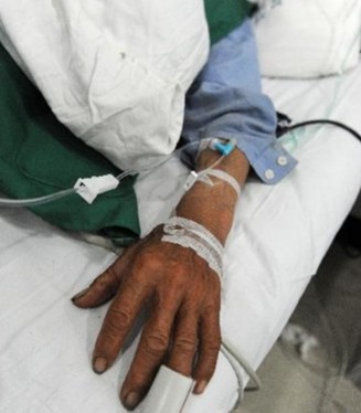 亚硝酸盐中毒后患者指尖呈青紫色