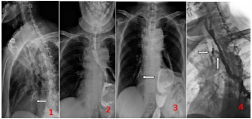 动态DR在食管气管瘘检查中的应用