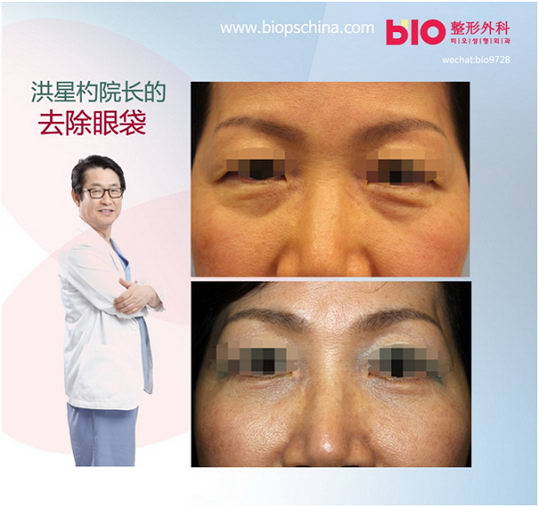 消除衰老元凶的眼袋手术