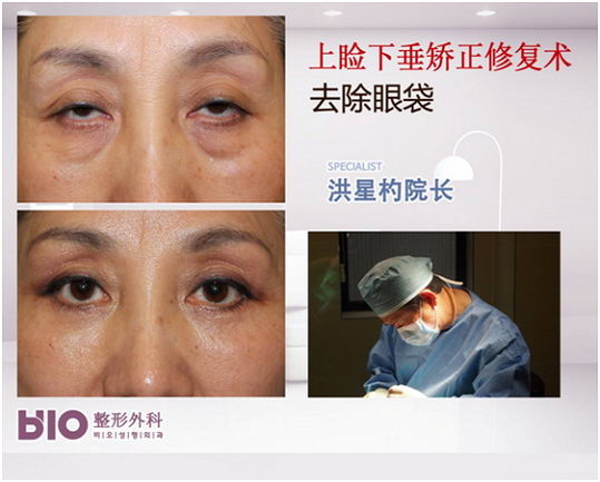 消除衰老元凶的眼袋手术