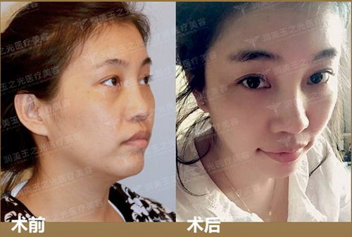 王明利:丰苹果肌