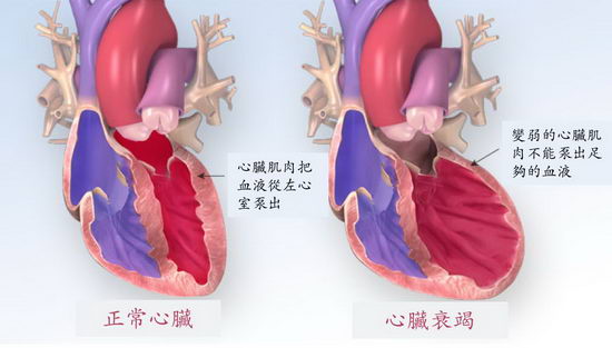 心脏衰竭患者日益增加  新一代双效药物可减入院及死亡率