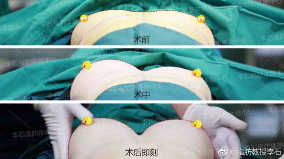 圣嘉荣李石院长:自体脂肪丰胸对身体有损害吗?