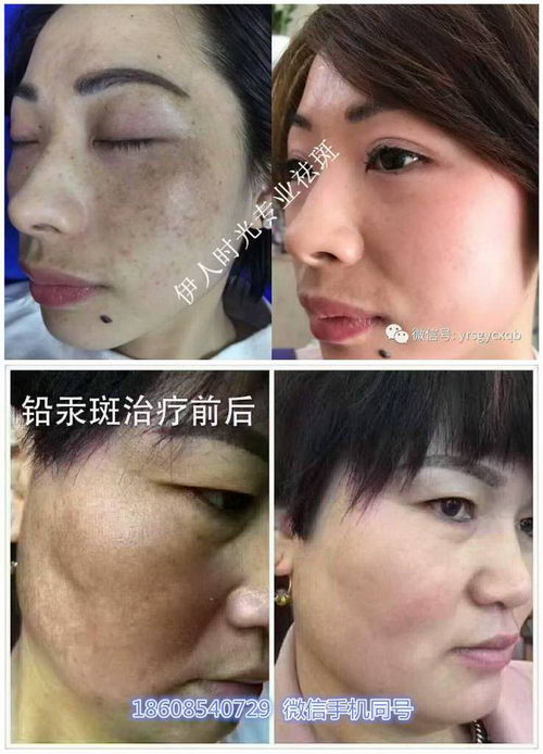 黄褐斑,老年斑有什么方法祛除?伊人时光有用吗?