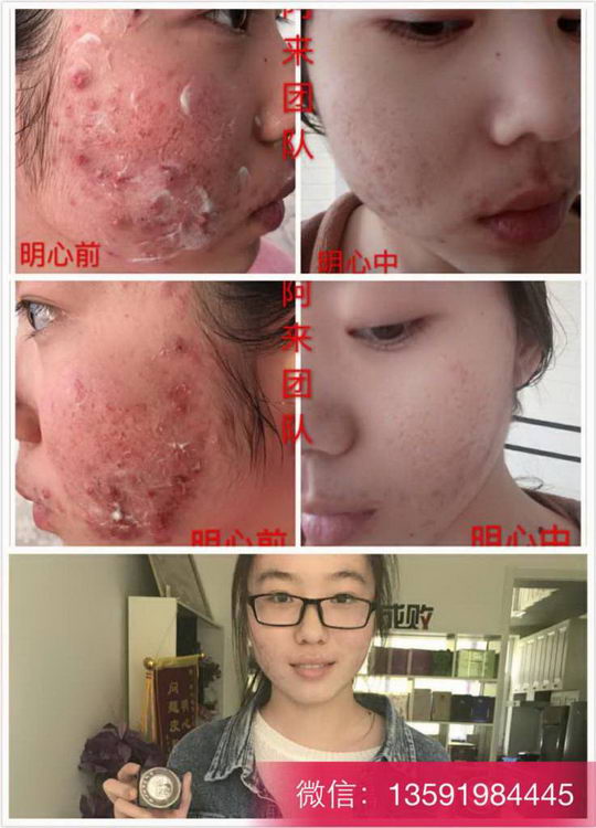 怎么去痘印?有什么好办法?明心祖传创始人阿灵教你