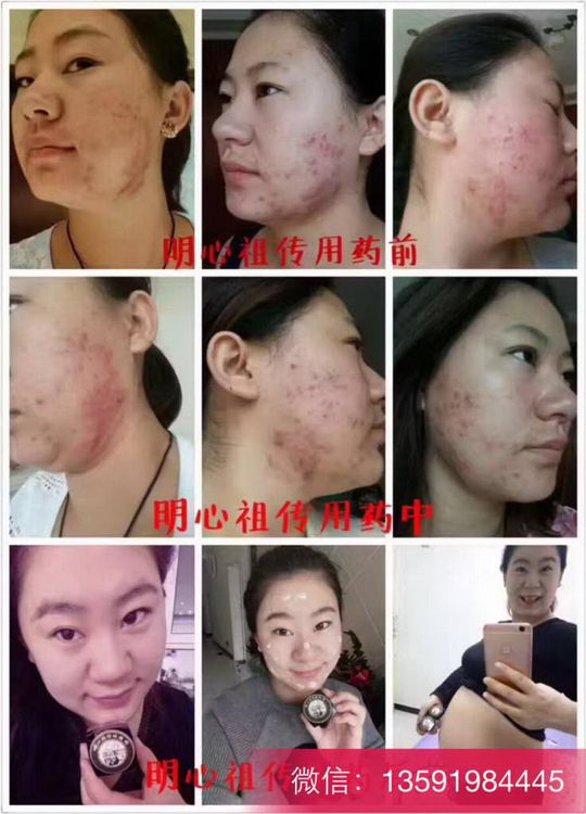 怎么去痘印?有什么好办法?明心祖传创始人阿灵教你