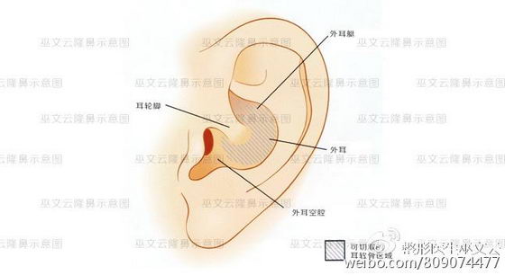 北京米扬丽格巫文云院长讲解耳软骨隆鼻尖手术