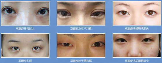 Ϊʲô˫Ƥʧ޸ԽԽ޸-ϲ˫Ƥ޸