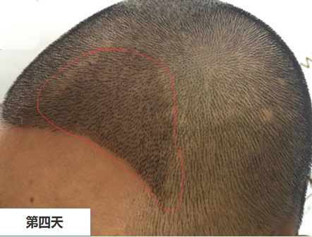 梁爱峰提倡发际线种植应遵循“宁高勿低”原则