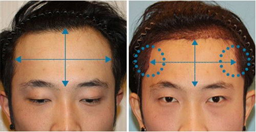 梁爱峰提倡发际线种植应遵循“宁高勿低”原则