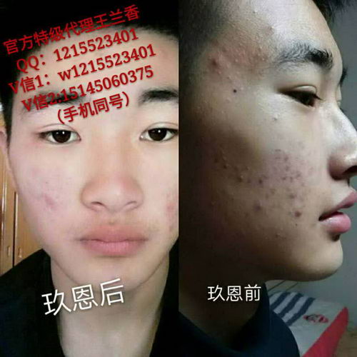 玖恩青春定格原液对于激素脸效果好用