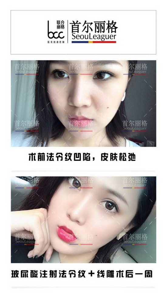 PPDO线雕选上海首尔丽格 逆转时光回复青春