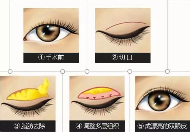 上海美立方美容咋样 有个好看的双眼皮是怎样的体验?