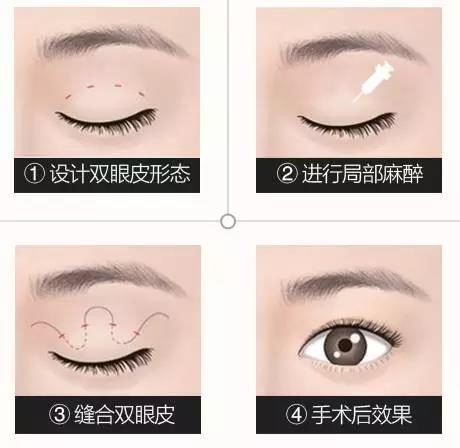 上海美立方美容咋样 有个好看的双眼皮是怎样的体验?