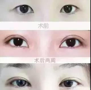 上海美立方美容咋样 有个好看的双眼皮是怎样的体验?