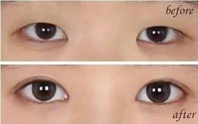上海美立方美容咋样 有个好看的双眼皮是怎样的体验?