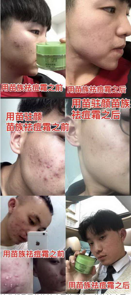 痘痘烦恼应该是我们大多数年轻人遇到的共同问题!