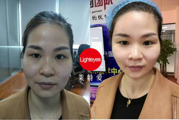 莱特爱量子五官塑,为您塑造完美轮廓