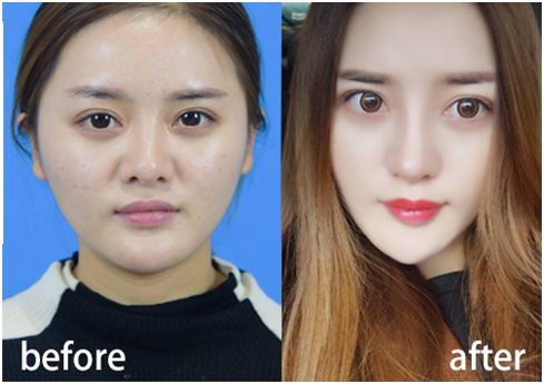 上海美立方谭拯院长肋软骨鼻整形高级研修班开班啦