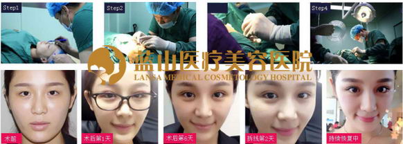 石家庄哪家医院埋线双眼皮好—王兴奎院长