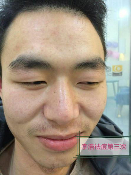 快速去黑头?痘院长祛痘