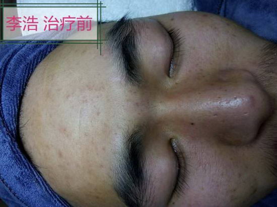 快速去黑头?痘院长祛痘