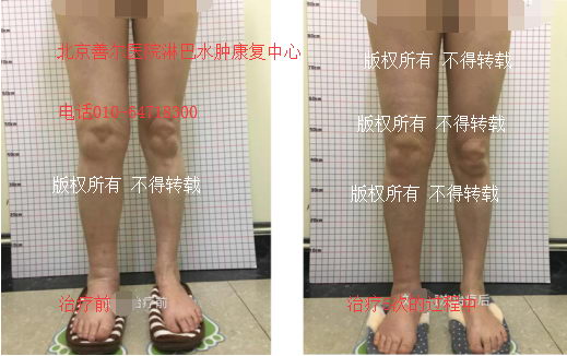 北京善尔医院分享:子宫切除术与盆腔淋巴结清扫术后淋巴水肿治疗