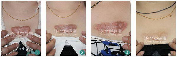 疤痕疙瘩治疗被坑怎么办?2招分辨病例真假防被骗