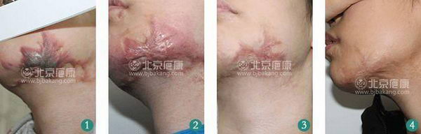 疤痕疙瘩治疗被坑怎么办?2招分辨病例真假防被骗