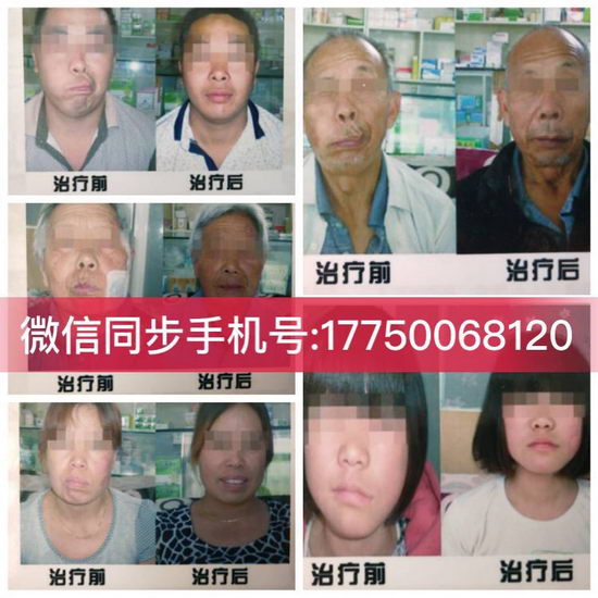 面瘫三个月以上还能好吗?泉州哪里可以治疗