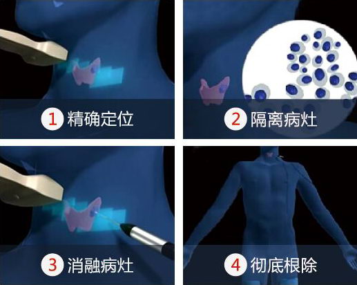 西安RFA甲状腺微创消融术,让甲状腺治愈率遥遥领先
