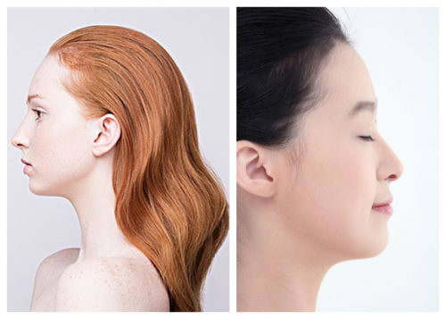 肋软骨塑造混血小翘鼻综合 鼻翼鼻尖要先解后构