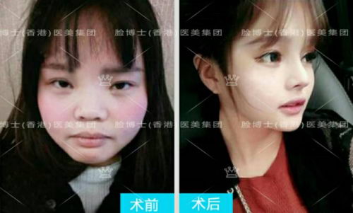 肋软骨塑造混血小翘鼻综合 鼻翼鼻尖要先解后构