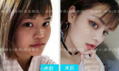 肋软骨塑造混血小翘鼻综合 鼻翼鼻尖要先解后构