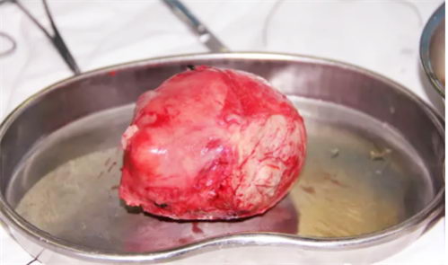 漳州都市医院:剖腹产手术成功,一箭双雕剔除子宫肌瘤