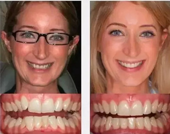 淮安诺贝尔口腔隐形矫正牙齿│牙齿矫正的理想选择!