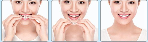 淮安诺贝尔口腔隐形矫正牙齿│牙齿矫正的理想选择!