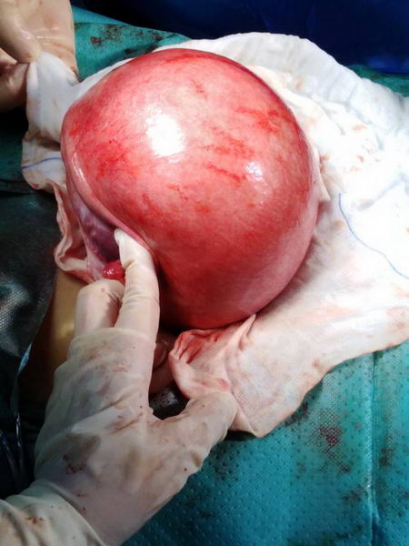 女子体内大家伙,美福宝专家成功“卸货”