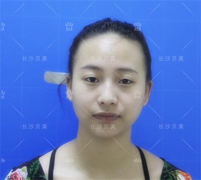 长沙贝美冯涛院长/双眼皮术后多久能恢复?几天可以沾水?