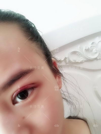 长沙贝美冯涛院长/双眼皮术后多久能恢复?几天可以沾水?