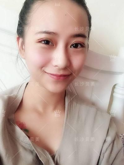 长沙贝美冯涛院长/双眼皮术后多久能恢复?几天可以沾水?