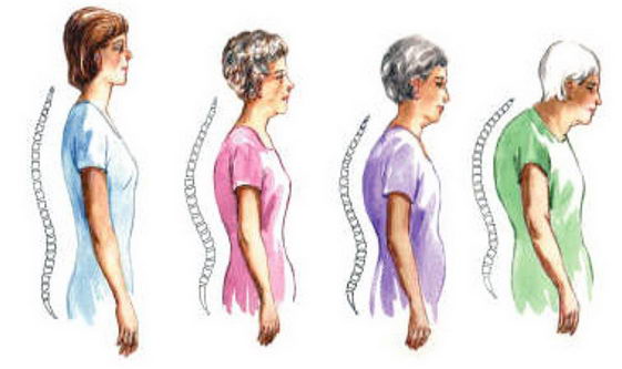 65岁以上女性为什么要做骨质疏松检查?