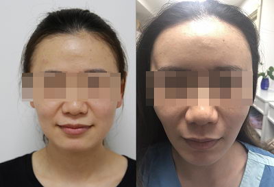 邱立东:毕业季整容热,学生求美需谨慎!