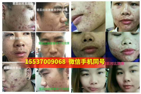 爱蕊丝皮肤管理治疗雀斑有效吗|会不会反弹|多久见效