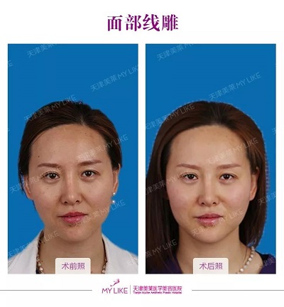 天津美莱桑亦松院长出席2018国际悦升线雕年轻化交流会!