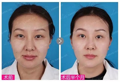 天津美莱桑亦松院长出席2018国际悦升线雕年轻化交流会!