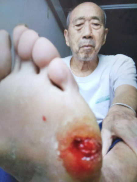 “圣禾灵”降糖产品糖尿病案例——徐道本