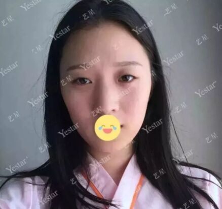 小眼睛,单眼皮的眼睛,竟然可以美成这样,感谢北京艺星做的双眼皮