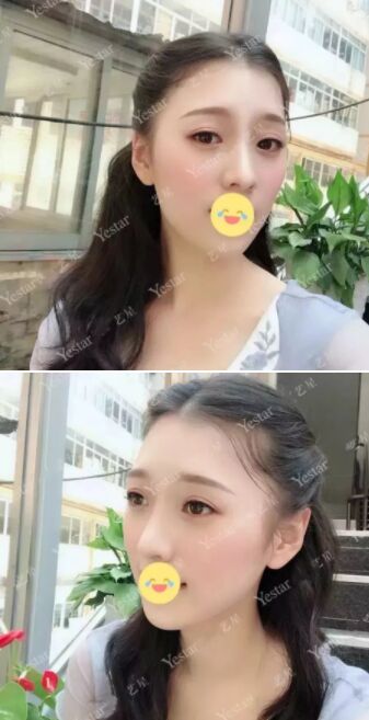 小眼睛,单眼皮的眼睛,竟然可以美成这样,感谢北京艺星做的双眼皮