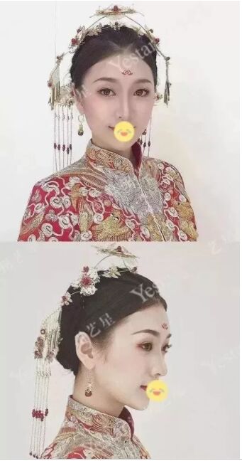 小眼睛,单眼皮的眼睛,竟然可以美成这样,感谢北京艺星做的双眼皮